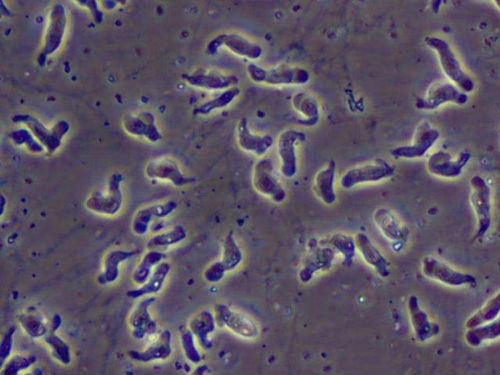 candidíase garganta_carinhas de halloween_carcinoma ductal invasivo grau nuclear 3